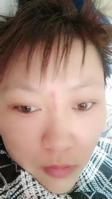 揪痧治咽炎的主播照片